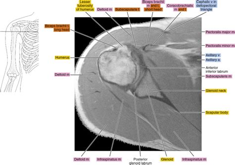 Mri Of The Shoulder Radiology Key