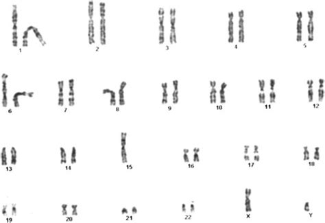 The karyotype of the AS patient. The cytogenetic image displays 45 ...