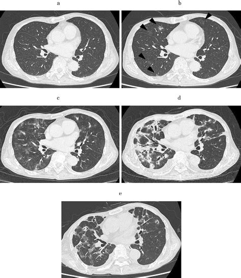 Table From A Case Of Lenvatinib Induced Interstitial Pneumonia In A