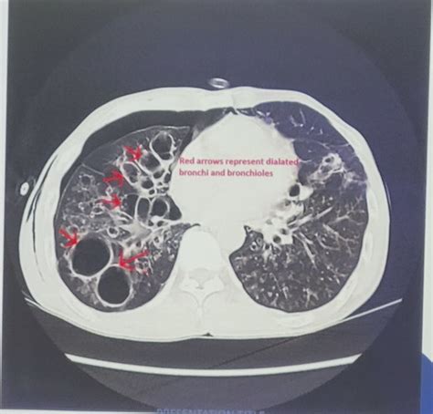 Test Review Ph Asthma Ild Imaging Flashcards Quizlet