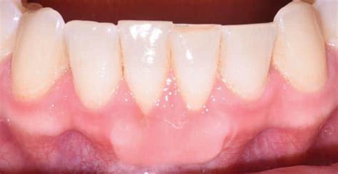 A Free Gingival Graft Saves the Day - Dimensions of Dental Hygiene