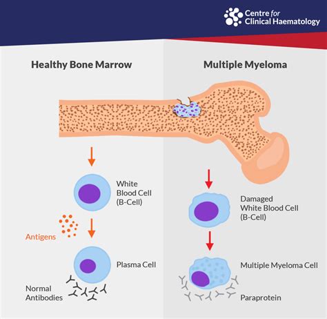 Myeloma: Signs, Diagnosis & Treatments in Singapore