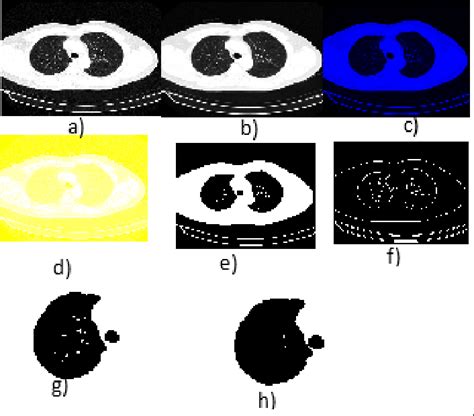 Figure 3 From Detection And Localization Of Early Stage Lung Tumor Using K Means Clustering And