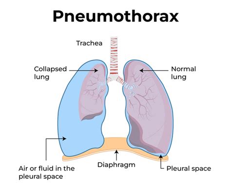 Difference Between Pneumothorax And Tension Pneumothorax Geeksforgeeks