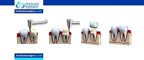 Dental Crown procedure | dental crown procedure pain | Iranian Surgery