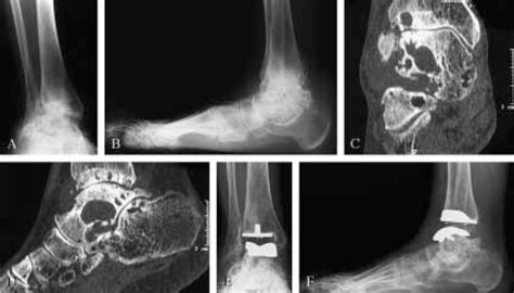 A B Preoperative Ap And Lateral Weightbearing Radiographs Of Ankle