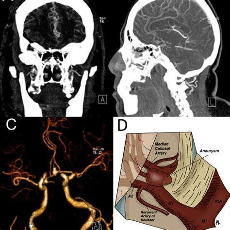 Preoperative Aneurism A B Preoperative Ct Angiography In Coronal And