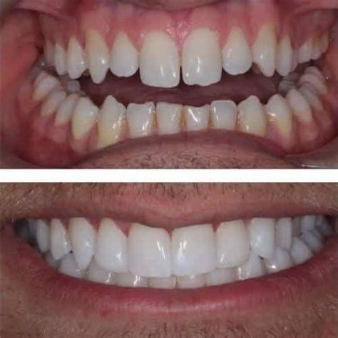 Composite Bonding Before And After - Book FREE Consultation