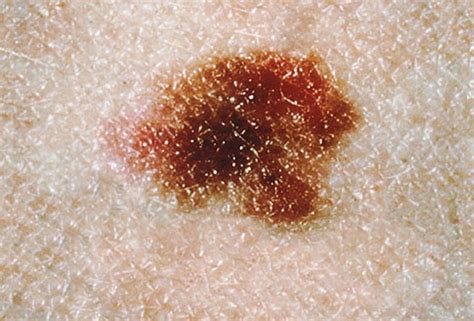 Conditions That Mimic Melanoma To The Naked Eye Scary Symptoms