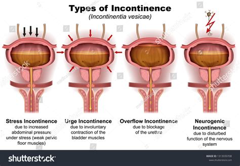 Stress Incontinence Over 106 Royalty Free Licensable Stock Vectors