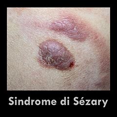 Sindrome di Sézary disturbi accertamenti e nuove terapie ISSalute