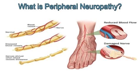 Diabetic Peripheral Neuropathy Pain Treatment Padda Institute