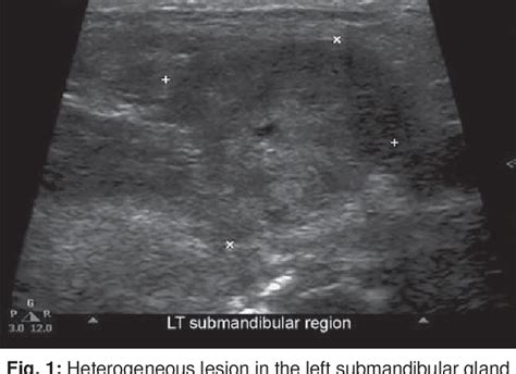 Figure 1 From Küttners Tumor Of The Submandibular Gland A Rare Case