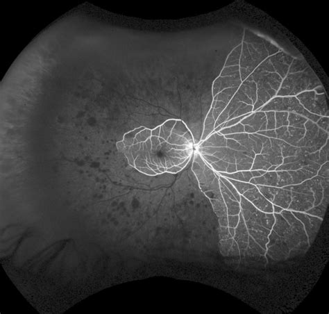 Optos Ultra Widefield Imaging Northern Sydney Cataract