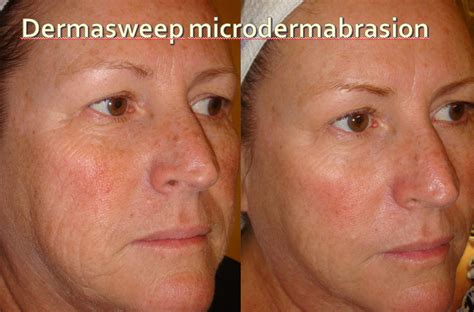 Microdermabrasion For Back Acne Scars Before And After