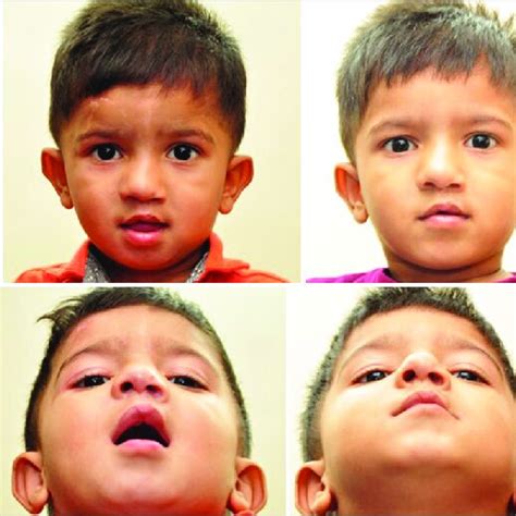 Unilateral Cleft Lip Deformity Pre Versus Post A Frontal And B