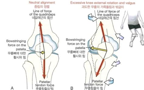 Tfltensor Fasciae Latae 대퇴근막장근 넙다리근막긴장근 네이버 블로그