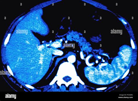 Abdominal ct scan abdomen Banque de photographies et dimages à haute