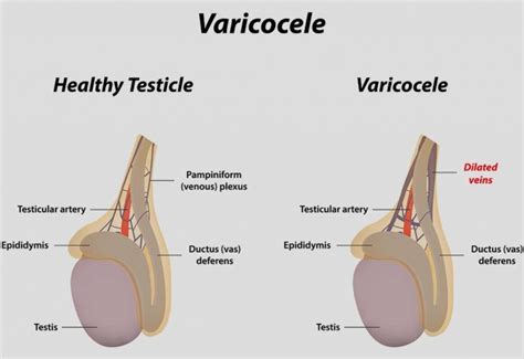 🎖 Varicocele E Infertilidad