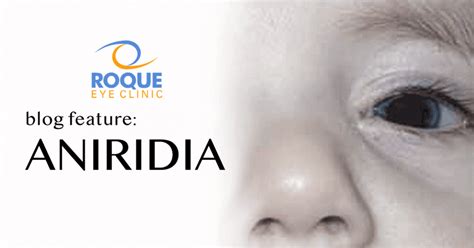 Aniridia (Absence of an Iris) | Roque Eye Clinic