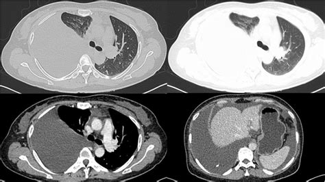 Contrast Enhanced Ct Scan Showed Massive Pleural Effusion In The Right