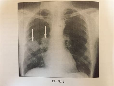 XRAYS OF PRIMARY TUBERCULOSIS