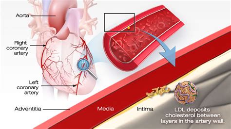 High Cholesterol Arteries