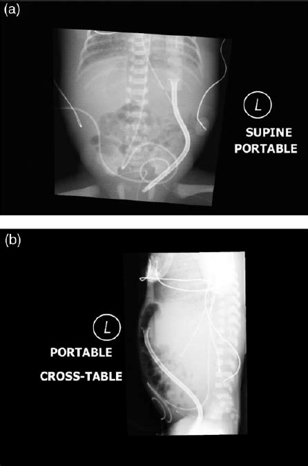 ( a ) AP X-ray demonstrating PD catheter placement coursing from the ...