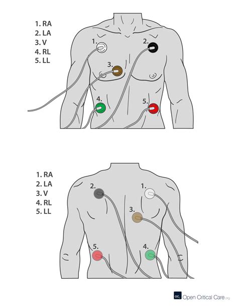 Where Is The Green Electrode Placed For The Holter Monitor At Marlene