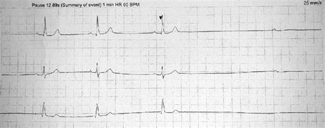 A Three Lead Holter Monitor Trace Demonstrating The Onset Of Cardiac