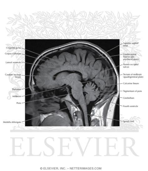 T Sagittal Mri