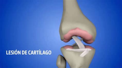 Clinica De Rodillas La Mejor Clinica De Ortopedia De México Lesion De Cartilago Youtube