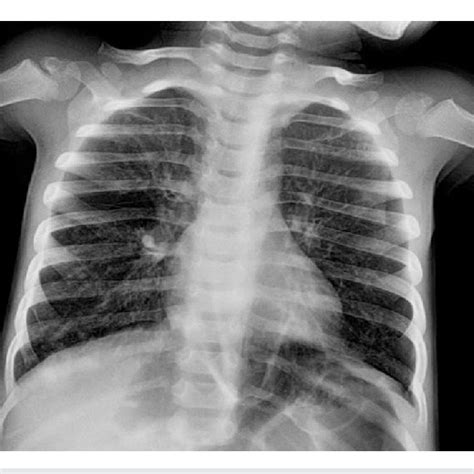 Human metapneumovirus infection and clinical signs in patients with ...