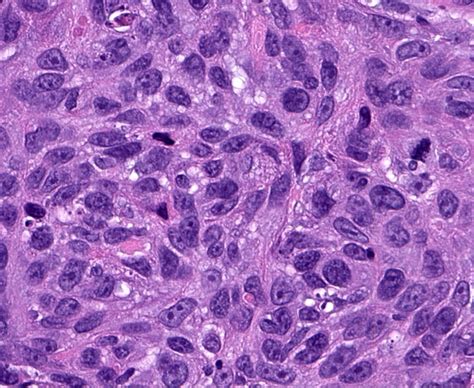 Pathology Outlines Squamous Cell Carcinoma Nos Hot Sex Picture