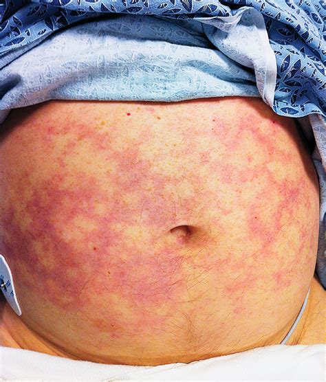 Thrombocytopenia Rash