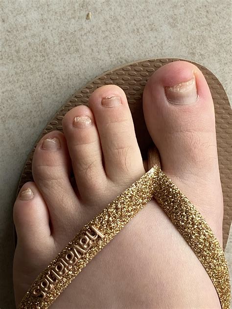 These Are My Results After Taking Terbinafine Every Day For 4 Months