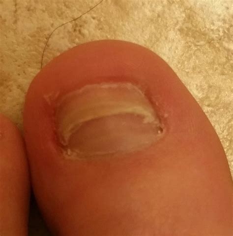 I Thought You Guys Might Enjoy My Ingrown Toenail You Can See My