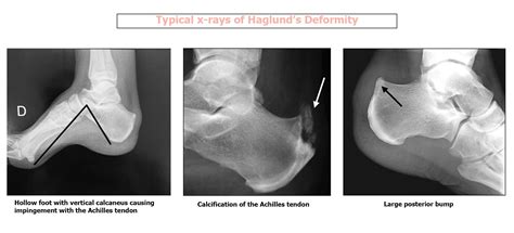 Haglunds Deformity Docteur Bruno Lévy