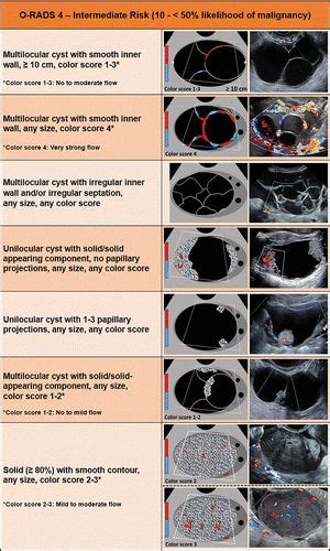 O Rads Us Risk Stratification And Management System A Consensus