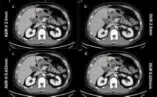 Evaluation Of Thin Slice Abdominal DECT Using Deep Learning Image