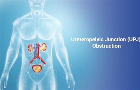 An Overview Of Ureteropelvic Junction Upj Obstruction