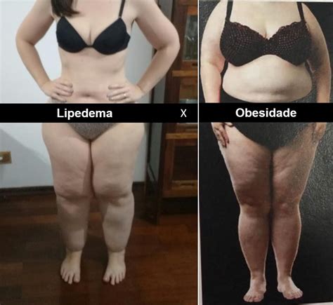 Você sabe o que é Lipedema