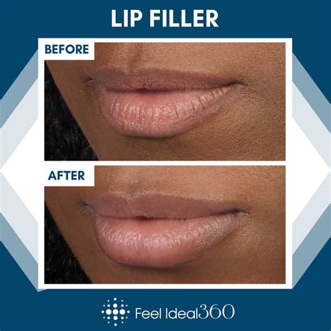 Lip Filler Before And After Feel Ideal Med Spa Southlake Tx