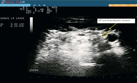 Non Hemodinamically Significant Internal Jugular Vein Stenosis Download Scientific Diagram