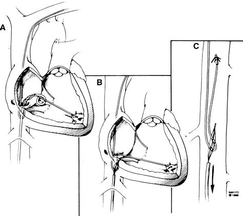 Lead Extraction Using The Femoral Vein Heart Rhythm