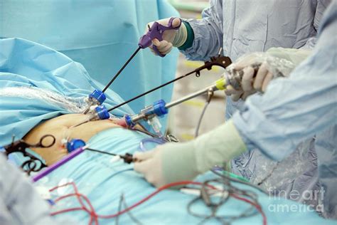 Gall Bladder Removal Surgery Photograph By Mark Thomasscience Photo Library Fine Art America