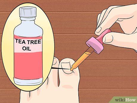 Ways To Heal An Ingrown Toenail Wikihow