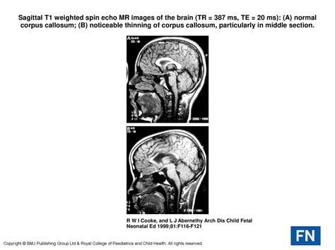 Sagittal T1 Weighted Spin Echo MR Images Of The Brain TR 387 Ms TE