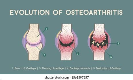 Osteoarthritis Destruction Cartilage Healthy Joint Unhealthy Stock