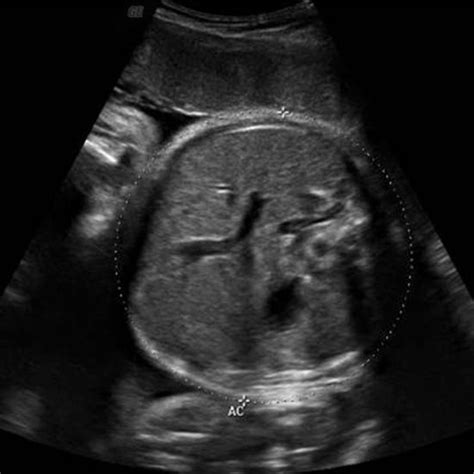 Third Trimester Ultrasound Pictures